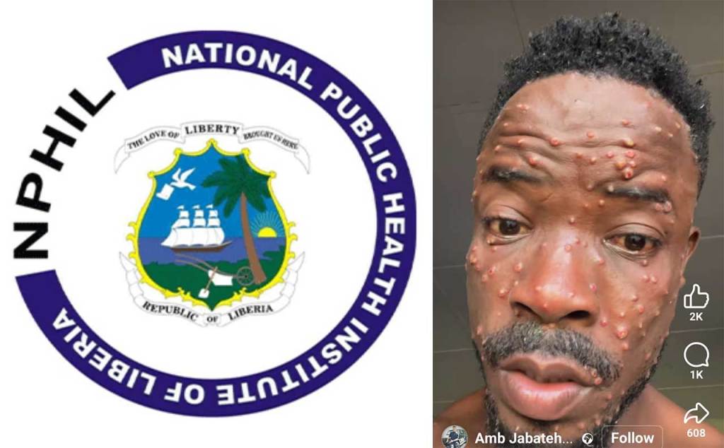 Liberian Scientists Detect and Identify Monkeypox virus Clade-IIb, Zero Deaths from Mpox Cases